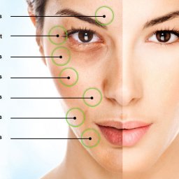 Microneedling Training Course